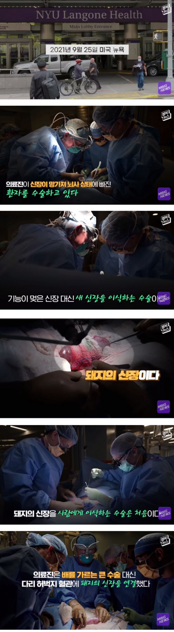사람에게 이식한 돼지 신장1.jpg